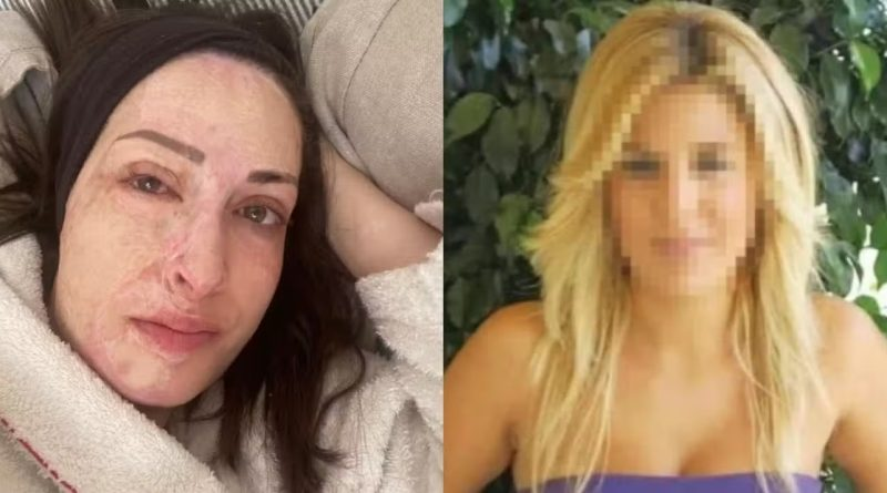 Επίθεση με Βιτριόλι: Η Ιωάννα Παλιοσπύρου μιλάει για την επίθεση